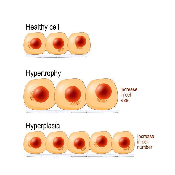 hypertrophy vs hyperplasia 